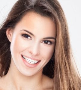 Aparelho ortodôntico: acessórios simples que podem ajudar na higiene