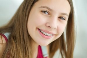 Aparelho Dental – Cuidados especiais para quem usa