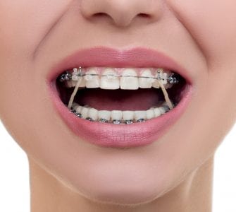 Elástico ortodôntico