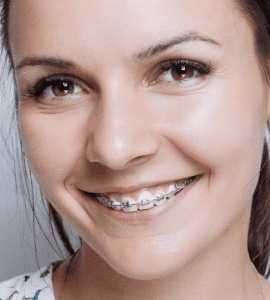 aparelho ortodôntico