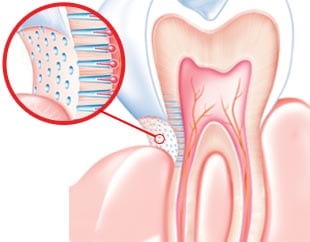 causas de sensibilidade nos dentes
