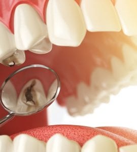 disfagia Quais são os diferentes tipos de cárie?