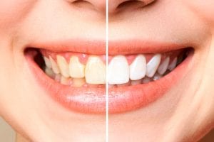 Como deixar os dentes brancos: dicas importantes e hábitos para adotar