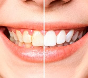 disfagia como deixar os dentes brancos