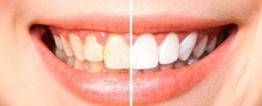 como deixar os dentes brancos