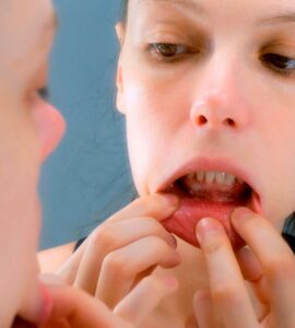 disfagia Ferida na boca