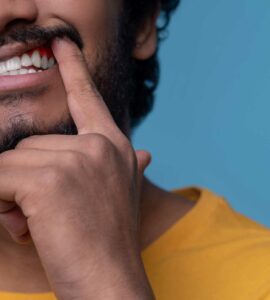 mancha branca na gengiva