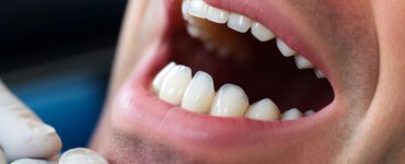 sensibilidade nos dentes