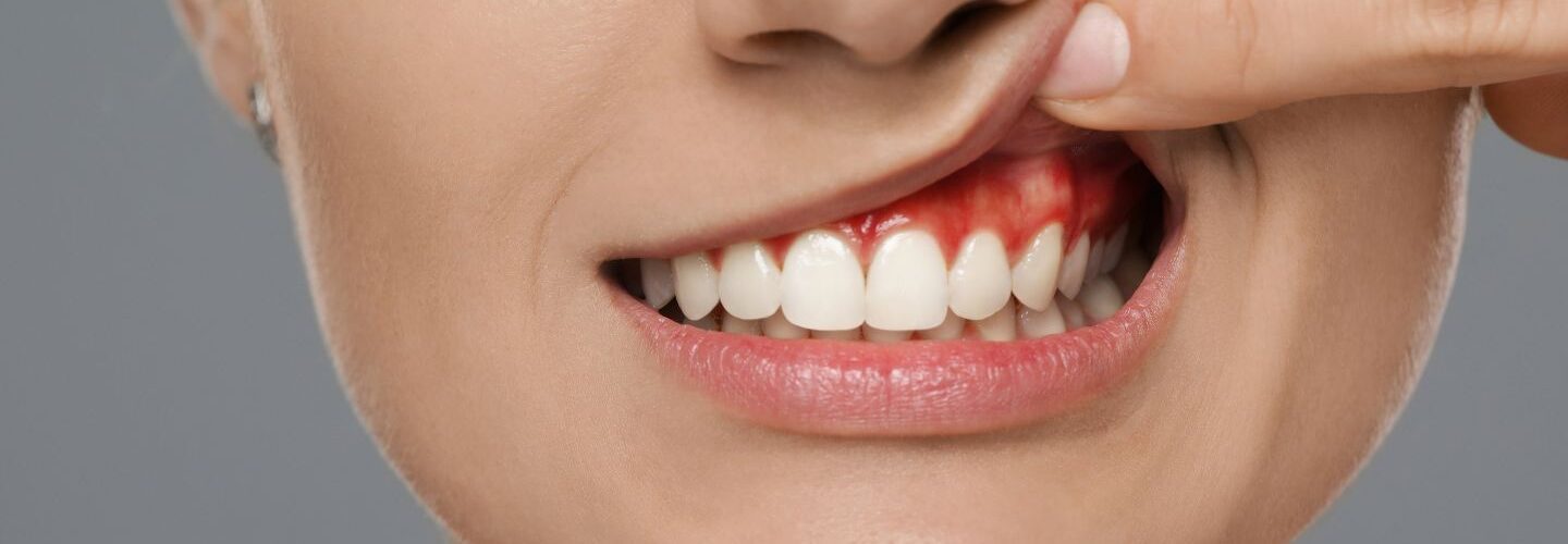 Como Tratar Gengivite Naturalmente