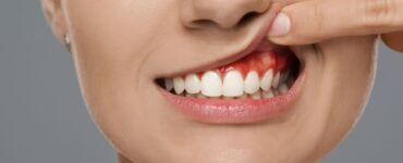 Como Tratar Gengivite Naturalmente