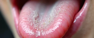 Halitose mostrando saburra na língua