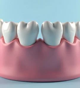 disfagia Representação 3D ultra-detalhada de dentadura com mordida cruzada mostrando alinhamento incorreto dos dentes superiores e inferiores