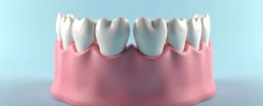Representação 3D ultra-detalhada de dentadura com mordida cruzada mostrando alinhamento incorreto dos dentes superiores e inferiores