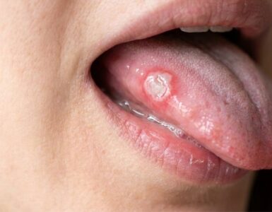 hipomineralização molar incisivo afta na língua