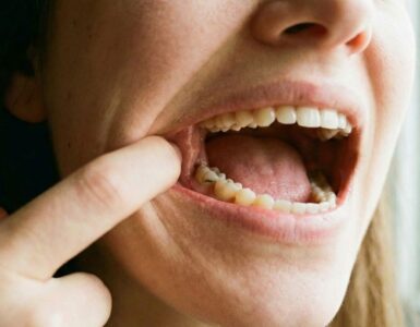 hipomineralização molar incisivo dente siso