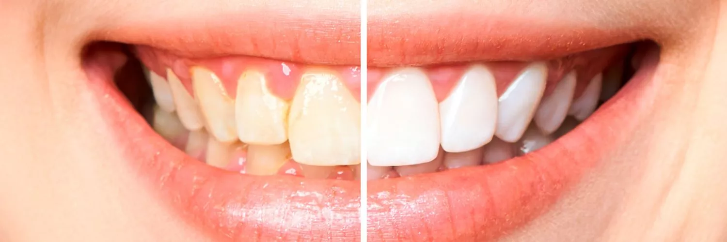 como deixar os dentes brancos